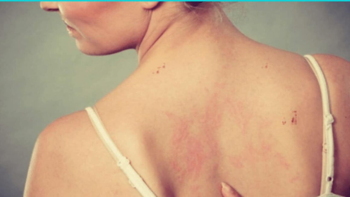 Tanning Bed Rash & How to Treat It Fashion on a Curve